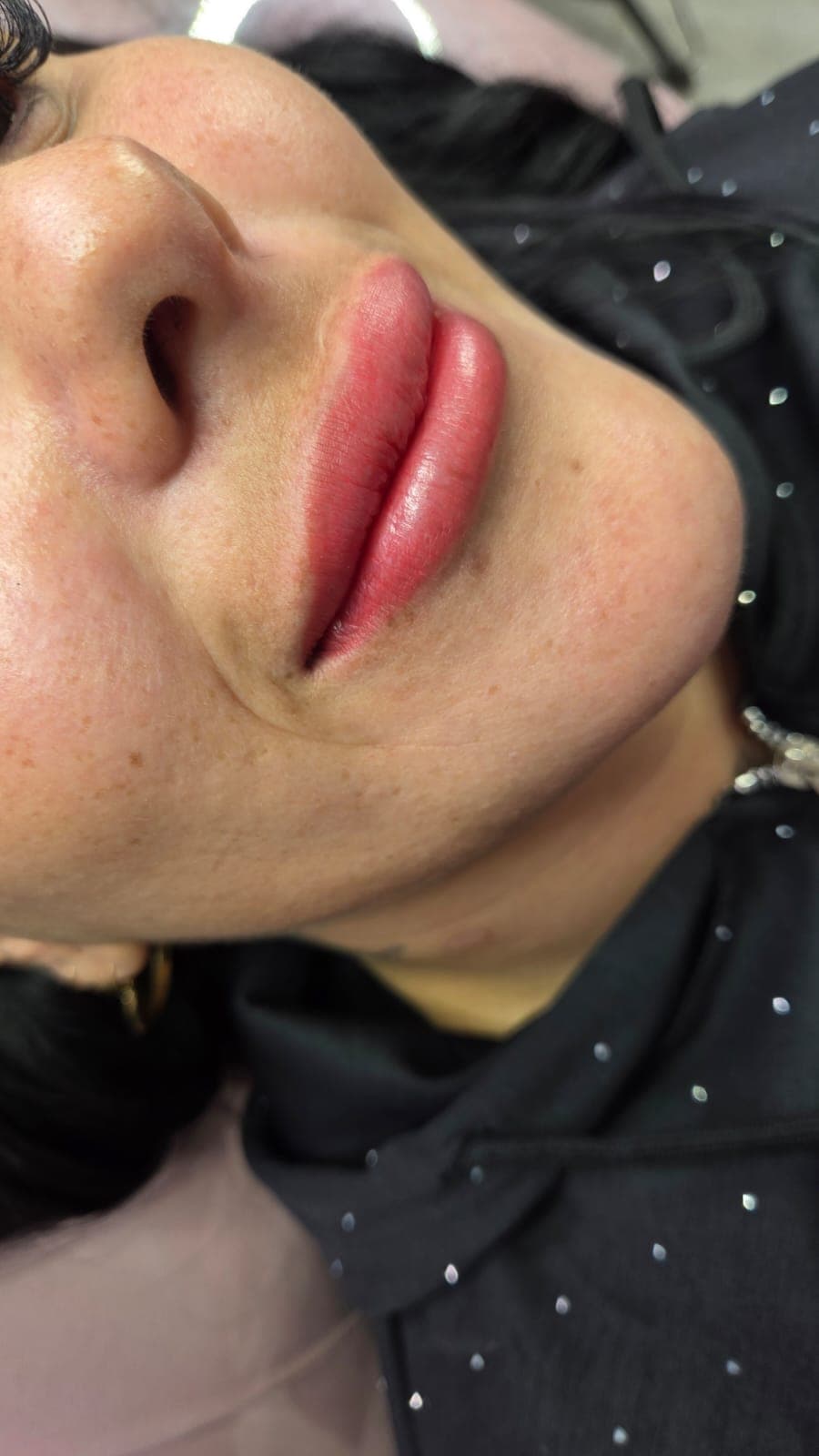 Tratamiento de labios